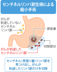 vol.97 胃がんでも行われている「腹腔鏡下センチネルリンパ節生検」