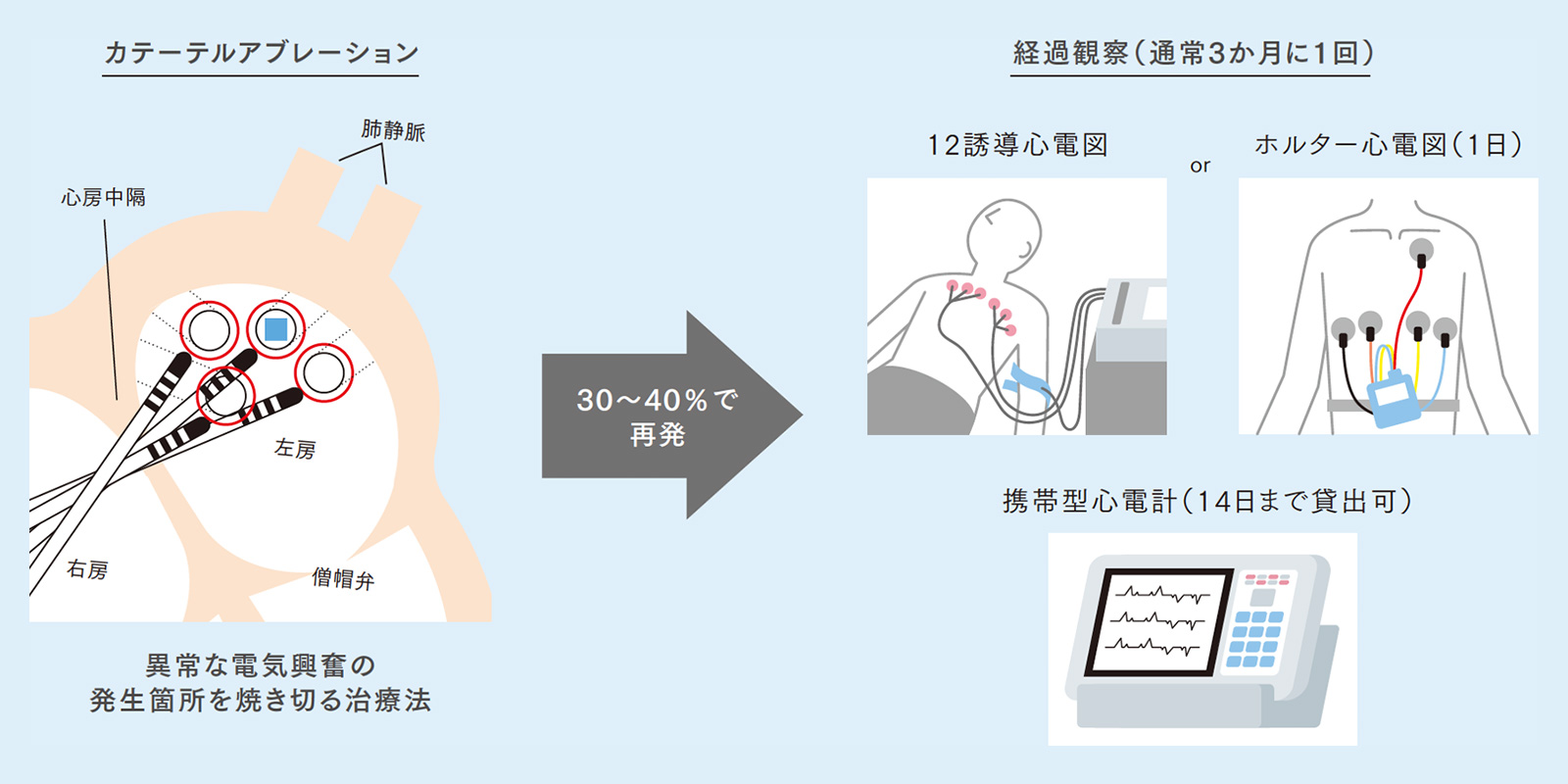 図：カテーテルアブレーション治療