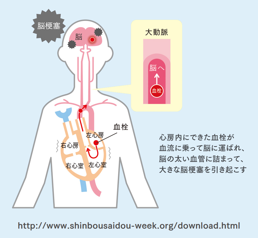 図1：心房細動と脳梗塞（心原性脳塞栓症）