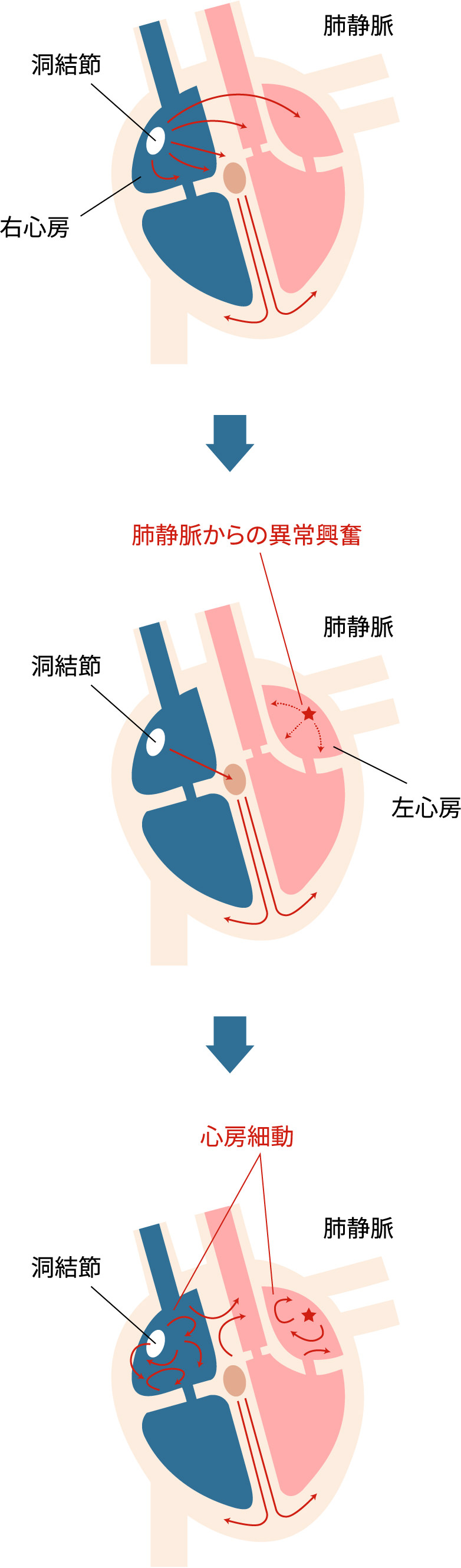 心房細動が起きる仕組み 図