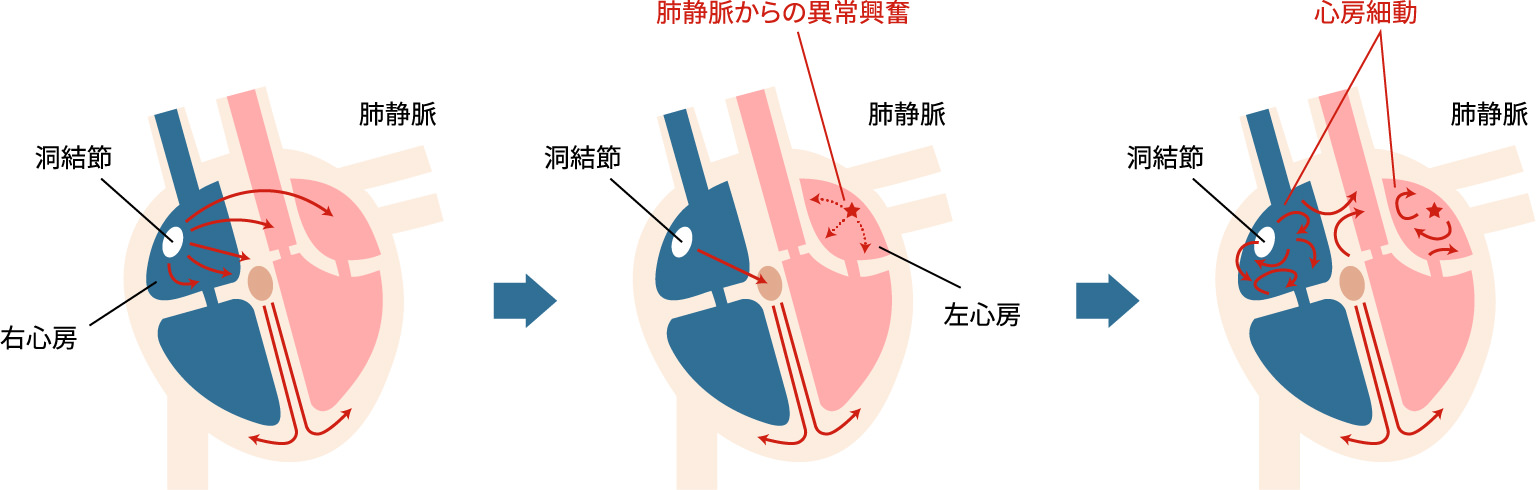 心房細動が起きる仕組み 図