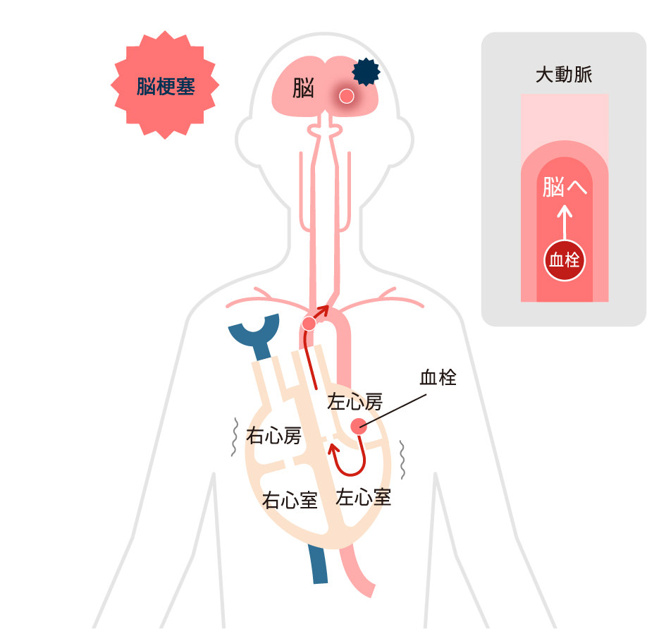 心房細動と脳梗塞(心原性脳塞栓症) 図