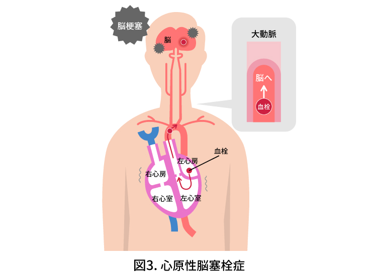 図3.心原性脳梗塞栓症