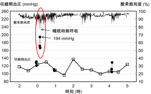 【睡眠時無呼吸に伴う血圧上昇の例】