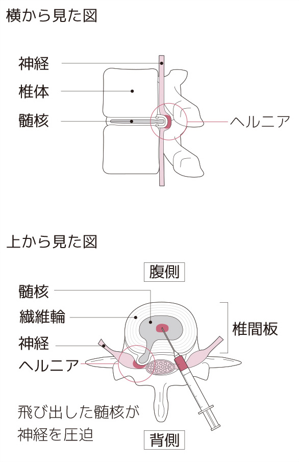 と 椎間板 は ヘルニア