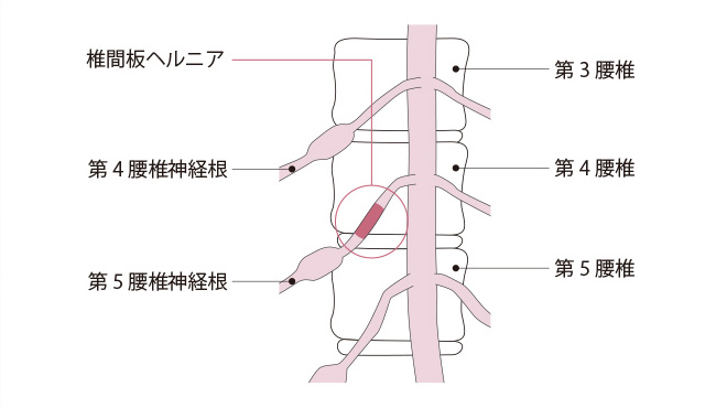 腰椎椎間板ヘルニアの症状