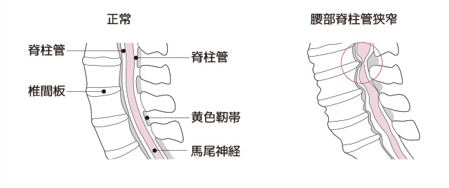 腰部脊柱管狭窄症はどんな病気？