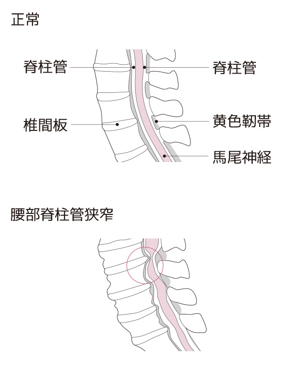 腰部脊柱管狭窄症とは何か 原因と症状 腰の痛み 痛みwith 腰部脊柱管狭窄症とは何か 原因と症状 腰の痛み 痛みwith