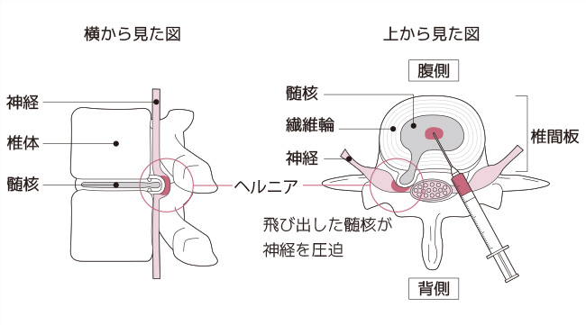 腰椎椎間板（ようついついかんばん）ヘルニア