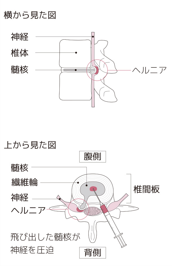 痛みの原因が特定できる 特異性腰痛 とは何か 腰の痛み 痛みwith