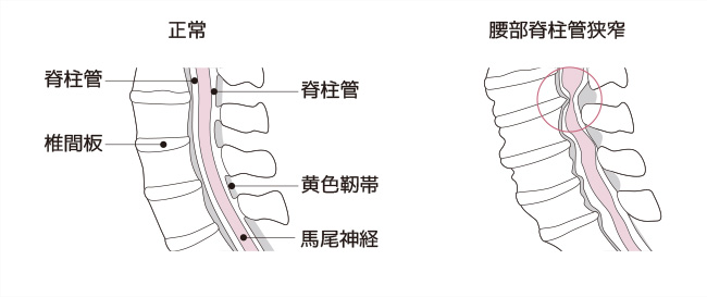 腰部脊柱管狭窄症（ようぶせきちゅうかんきょうさくしょう）