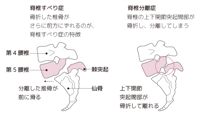 脊椎分離症・脊椎すべり症