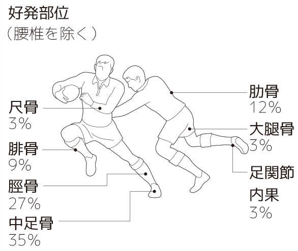 疲労骨折とは何か 起こる原因と部位 予防法など 骨折の痛み 痛みwith