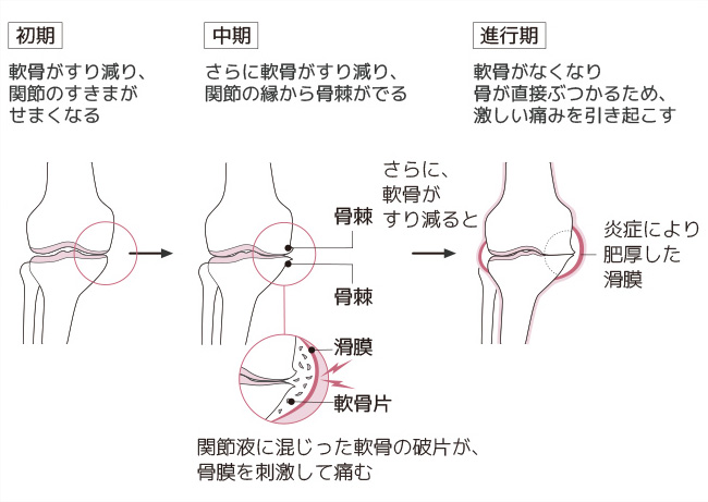 変形性膝関節症が進行する仕組み