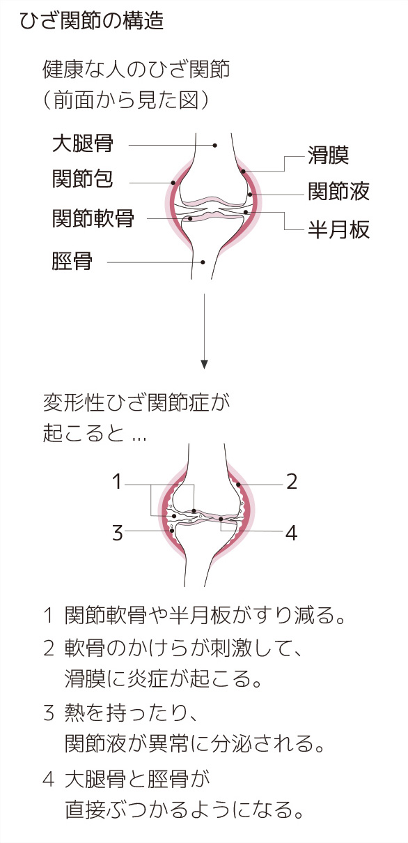 変形性膝関節症とは何か 初期症状から末期症状まで 膝の痛み 痛みwith