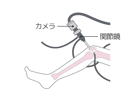 変形性膝関節症に効く3つの治療法 運動療法 薬物療法 手術療法 膝の痛み 痛みwith