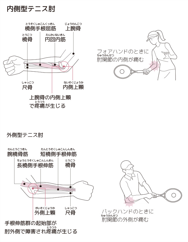 外側上顆炎 テニス肘と呼ばれる肘の外側の痛み の症状 原因と予防法 スポーツによる慢性の痛み 痛みwith