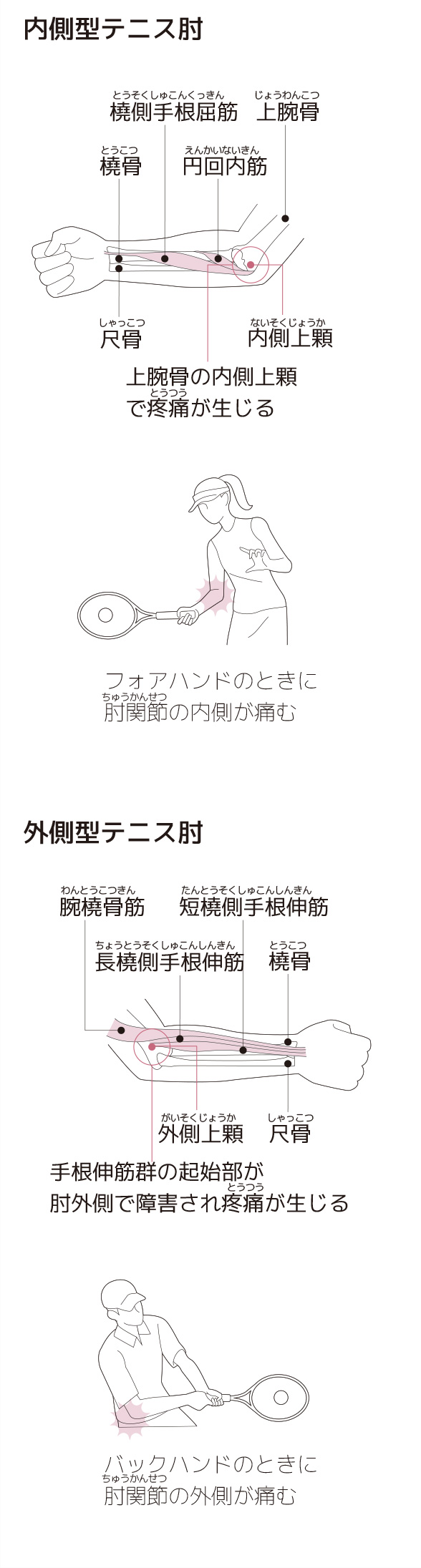 外側上顆炎 テニス肘と呼ばれる肘の外側の痛み の症状 原因と予防法 スポーツによる慢性の痛み 痛みwith