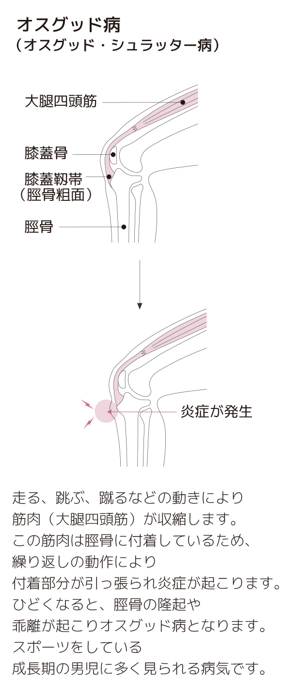 オスグッドとは 成長期に多い膝の痛みの原因と症状 スポーツによる慢性の痛み 痛みwith