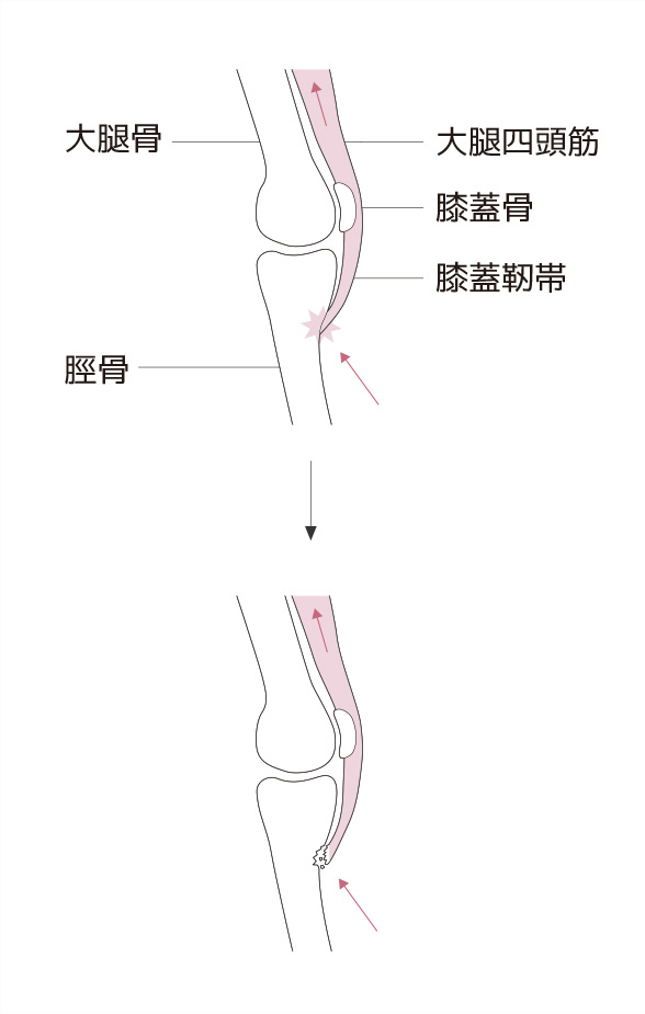 オスグッドとは 成長期に多い膝の痛みの原因と症状 スポーツによる慢性の痛み 痛みwith