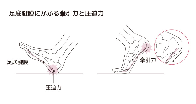 足底腱膜炎にかかる牽引力と圧迫力