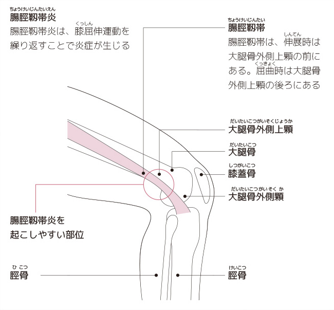 ランナー膝になる原因とメカニズム