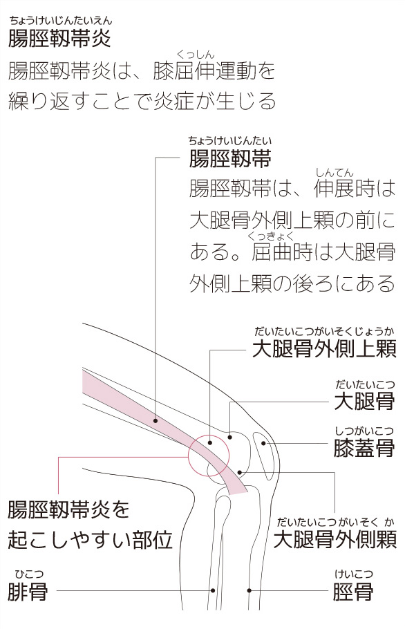 ランナー膝 腸脛靱帯炎 ほか ランニングで起きやすい膝の疾患と原因 スポーツによる慢性の痛み 痛みwith