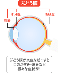 症状 髄 膜 炎