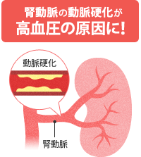 と は 硬化 動脈 [21] 動脈硬化