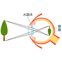 vol.21 白内障は早期発見で対策を