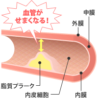 動脈 硬化 と は