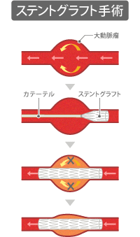 vol.95 腹部大動脈瘤の破裂予防に注目されるステントグラフト手術