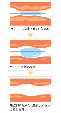 vol.13 狭心症・心筋梗塞治療に期待される薬剤溶出ステント