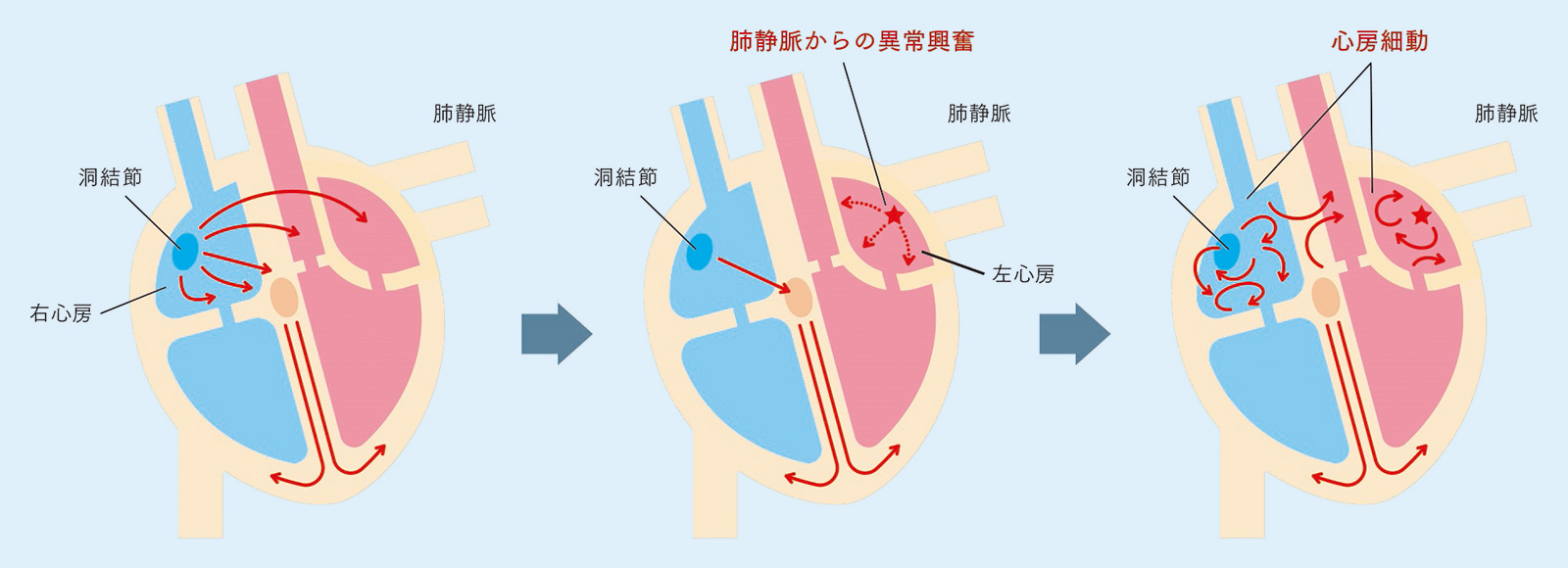 図1：心房細動が起きる仕組み
