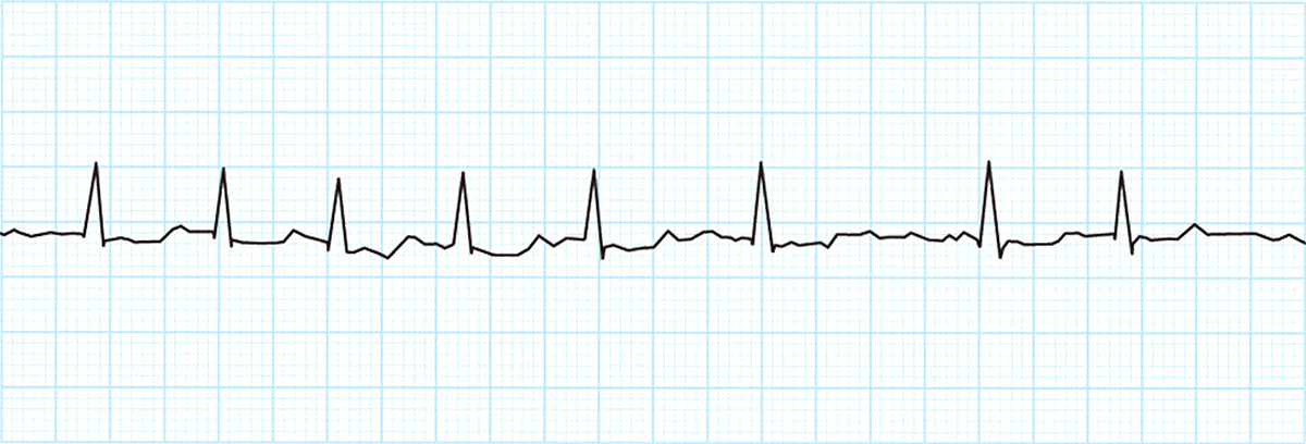心房細動の心電図と電気の流れ（イメージ）