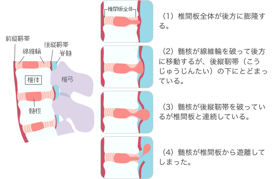 ヘルニア 治る のか